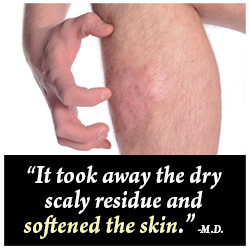 Scar-Ban Scar Lotion Customer Testimonial